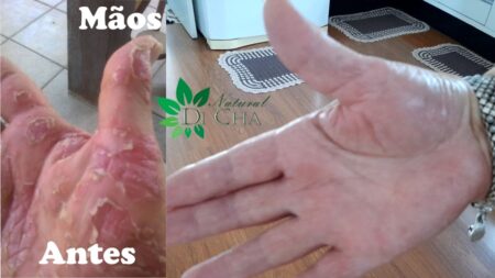 psoriase mão