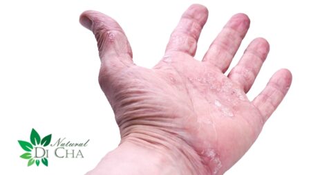 psoriase nas mãos